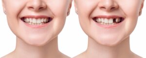 Young woman smiling before and after dental implant.