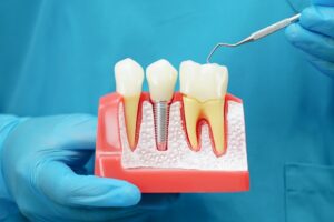 Do dental implants hurt